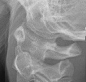 The Imaging Appearance and Possible Clinical Consequences of the Os Odontoideum
