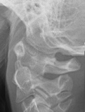 The Imaging Appearance and Possible Clinical Consequences of the Os Odontoideum