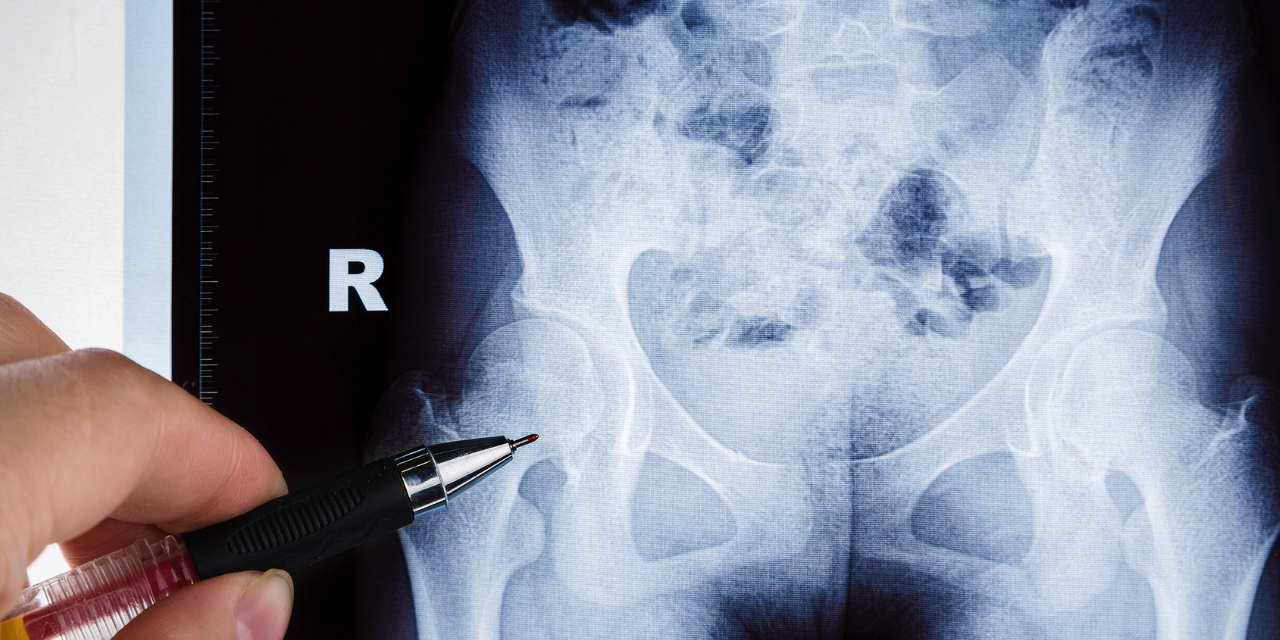 Radiology of Osteonecrosis