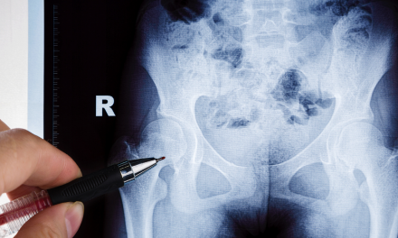 Radiology of Osteonecrosis