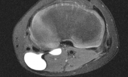 The MRI Appearance and Significance of the Popliteal Cyst