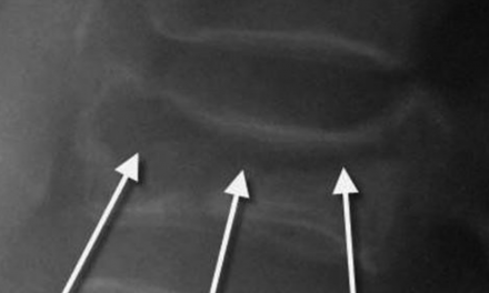 Kummell’s Disease (Delayed Vertebral Body Compression Fracture)