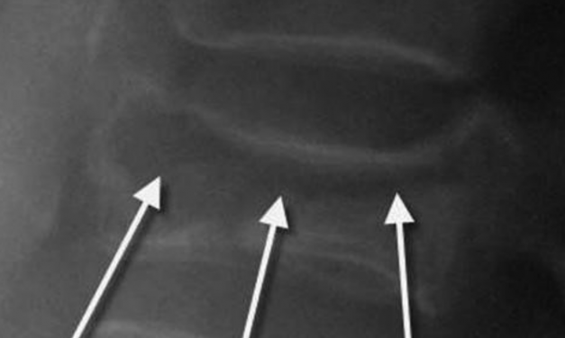 Kummell’s Disease (Delayed Vertebral Body Compression Fracture)