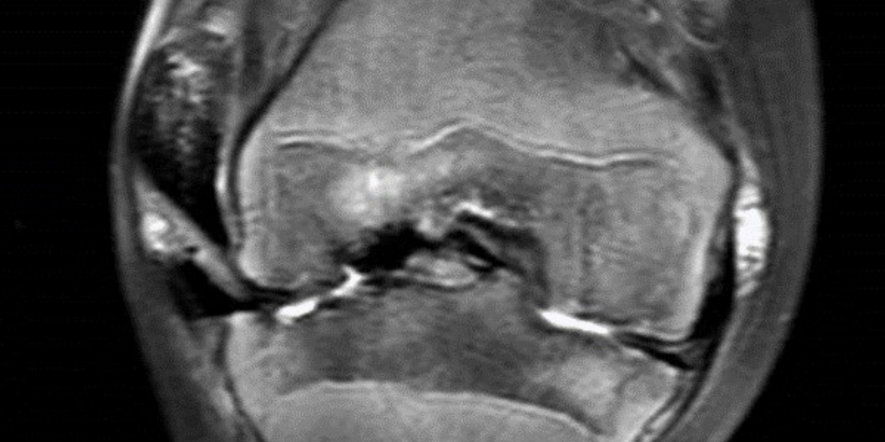 Radiology of Hemophilia