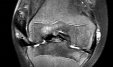 Radiology of Hemophilia