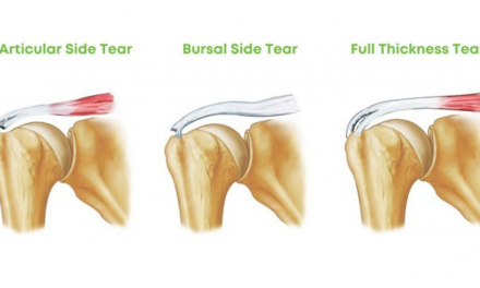 Is It a Full-Thickness or a Partial-Thickness Tear of the Rotator Cuff?