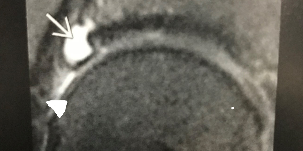 MRI Appearance of Acetabular Labral Tears