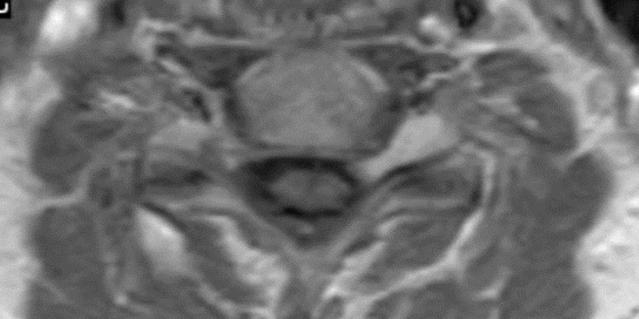 Spinal Schwannomas