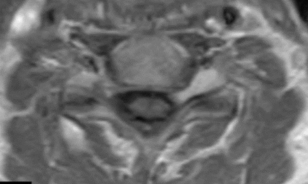 Spinal Schwannomas
