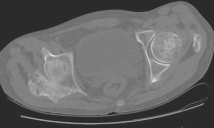 Soft Tissue Evaluation and Myositis Ossificans