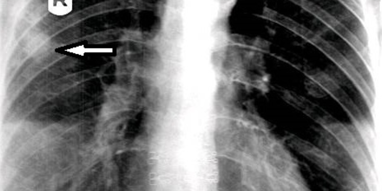 Bronchogenic Carcinoma on Thoracic Spine Study