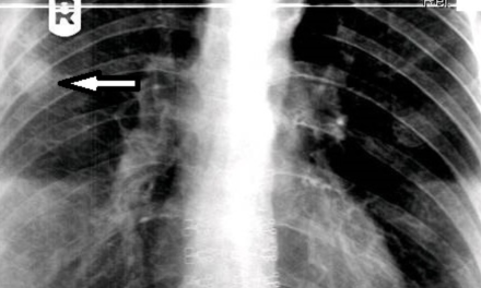 Bronchogenic Carcinoma on Thoracic Spine Study