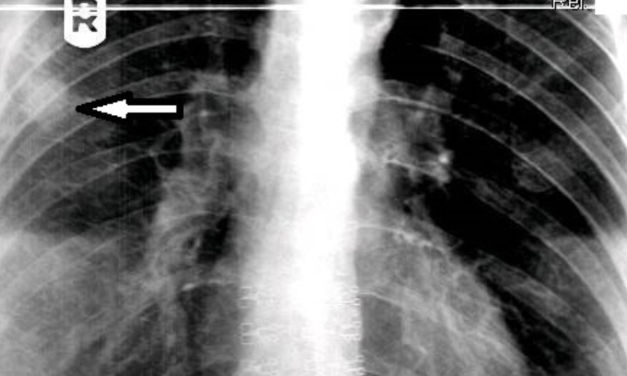 Bronchogenic Carcinoma on Thoracic Spine Study