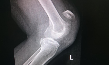 The MRI Appearance of Anterior Patellar Bursitis