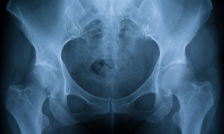 Microinstability of the Hip: An Emerging Diagnosis in the Athlete