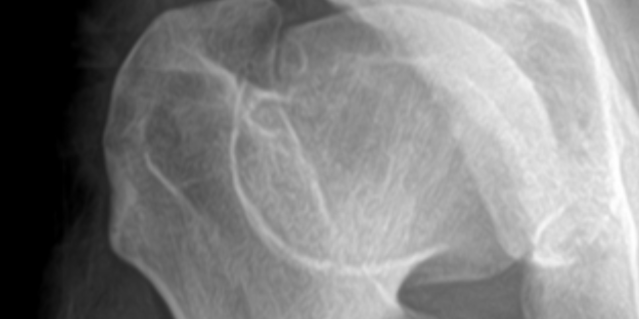 An Uncommon Cause of Hip Pain in an Adult: Healed Legg-Calve-Perthes Disease