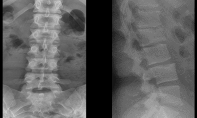 Lumbar Scheuermann’s Disease: A Rare Variation of A Commonly Understood Condition