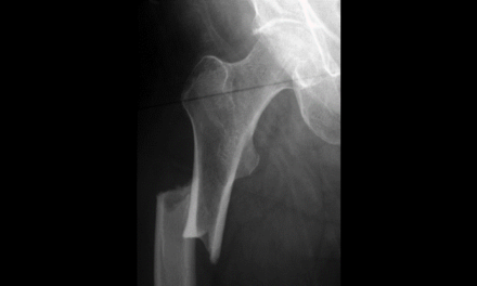 Atypical Proximal Femoral Fracture: An Important Diagnostic Consideration for Patients With Hip, Groin, Or Thigh Pain