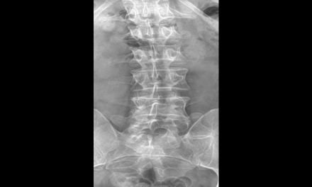Bertolotti Syndrome: A Potential Cause of Low Back Pain