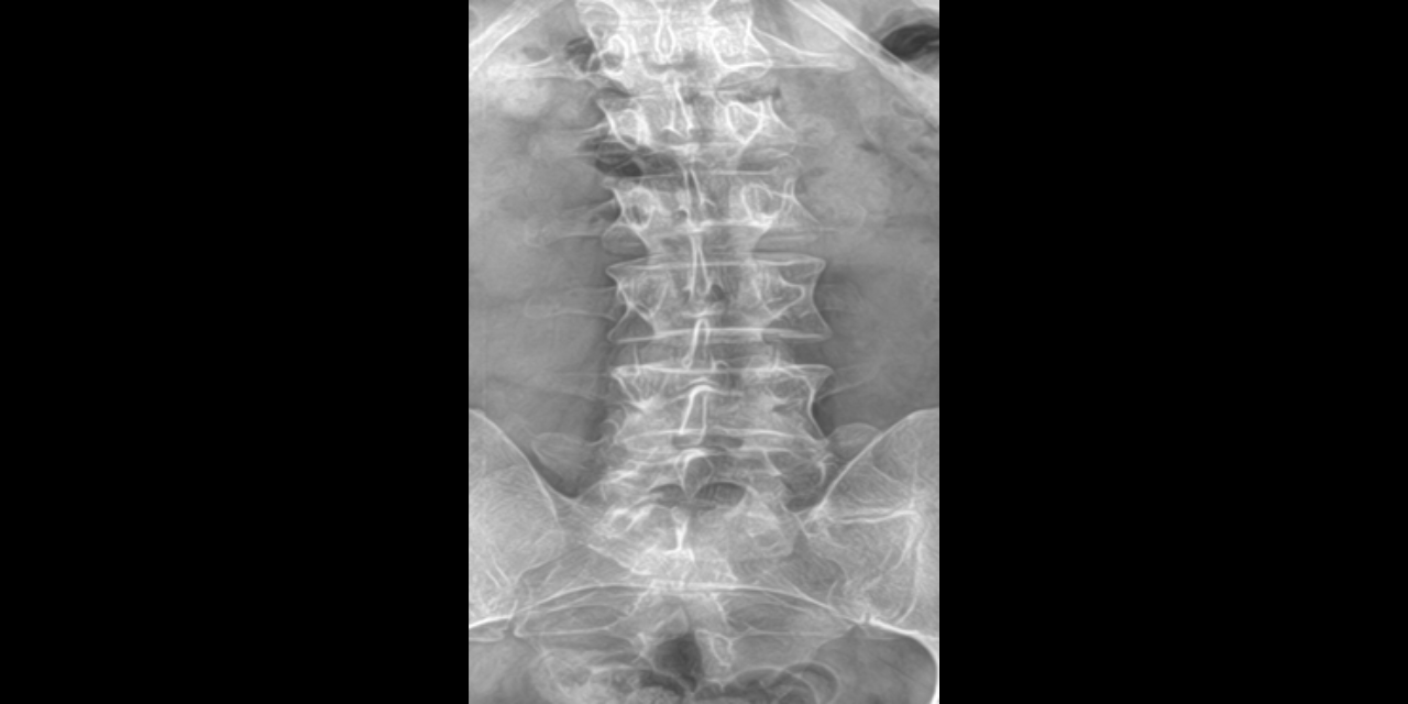 Bertolotti Syndrome: A Potential Cause of Low Back Pain