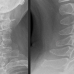 Top 5 Masqueraders of Osseous Disease on Radiographs