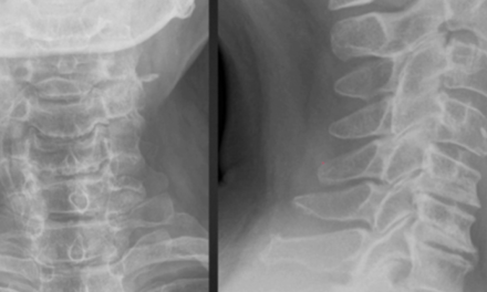 Top 5 Masqueraders of Osseous Disease on Radiographs