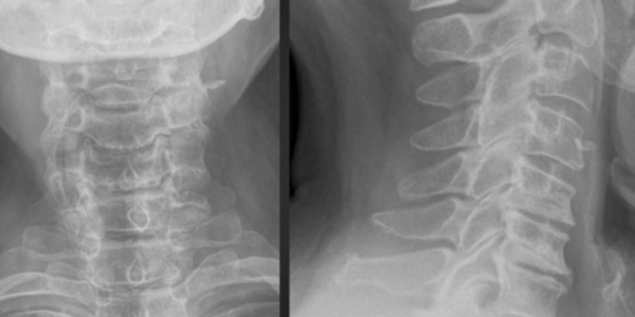 Top 5 Masqueraders of Osseous Disease on Radiographs